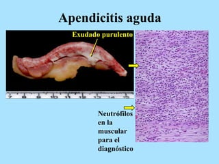 Apendicitis aguda
Neutrófilos
en la
muscular
para el
diagnóstico
Exudado purulento
 