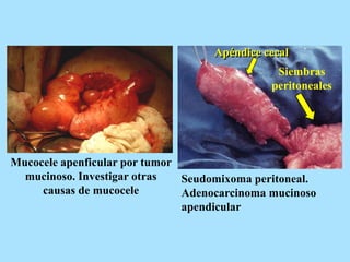 Mucocele apenficular por tumor
mucinoso. Investigar otras
causas de mucocele
Seudomixoma peritoneal.
Adenocarcinoma mucinoso
apendicular
Siembras
peritoneales
Apéndice cecal
 