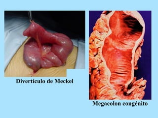 Divertículo de Meckel
Megacolon congénito
 