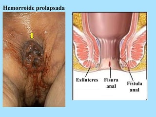 Hemorroide prolapsada
Fisura
anal Fístula
anal
Esfínteres
 