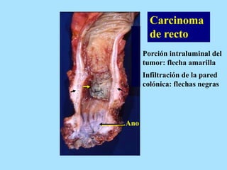Carcinoma
de recto
Porción intraluminal del
tumor: flecha amarilla
Infiltración de la pared
colónica: flechas negras
Ano
 