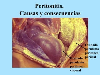 Peritonitis.
Causas y consecuencias
Exudado
purulento
peritoneo
parietalExudado
purulento
peritoneo
visceral
 