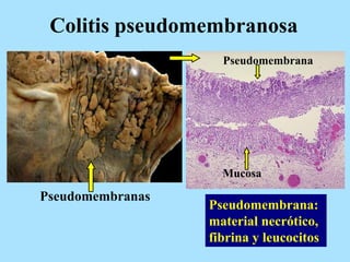 Colitis pseudomembranosa
Pseudomembranas
Pseudomembrana
Mucosa
Pseudomembrana:
material necrótico,
fibrina y leucocitos
 