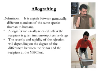 Allografting
Definition: It is a graft between genetically
different members of the same species
(human to human).
• Allografts are usually rejected unless the
recipient is given immunosuppressive drugs
• The severity and rapidity of the rejection
will depending on the degree of the
differences between the donor and the
recipient at the MHC loci.
 