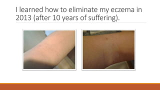 I learned how to eliminate my eczema in
2013 (after 10 years of suffering).
 