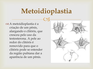 Metoidioplastia
                 
 A metoidioplastia é a
  criação de um pênis,
  alargando o clitóris, que
  cresceu pelo uso da
  testosterona. A pele ao
  redor do clitóris é
  removido para que o
  clitóris pode se estender
  da região pubiana dar a
  aparência de um pênis.
 