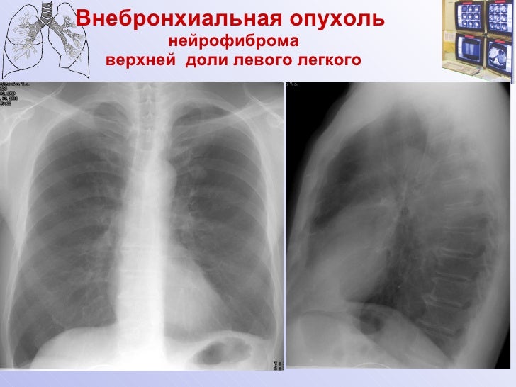 Гиповентиляция легких. Доброкачественные образования легких. Доброкачественные новообразования в легких. Доброкачественные опухоли легких рентген. Бугристое образование в легком.