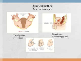 Surgical method
Мэс заслын арга

Tubaligation
Гуурс боох

Vasectomy
Үрийн цэврүү авах

 