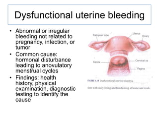 Dysfunctional uterine bleeding
• Abnormal or irregular
bleeding not related to
pregnancy, infection, or
tumor
• Common cause:
hormonal disturbance
leading to anovulatory
menstrual cycles
• Findings: health
history, physical
examination, diagnostic
testing to identify the
cause

 