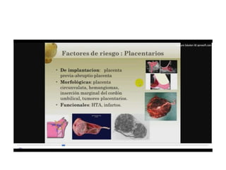 12.  parto pretermino - tocolisis