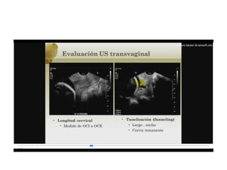 12.  parto pretermino - tocolisis