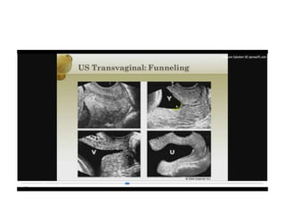 12.  parto pretermino - tocolisis
