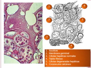31 
1 
2 
3 
4 
1. Escolices 
2. Membrana germinal 
3. Células hepáticas normales 
4. Tejido fibroso 
5. Células degeneradas hepáticas 
6. Corpúsculos calcáreos 
5 
6 
 