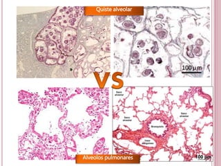 32 
Quiste alveolar 
Alveolos pulmonares 
 