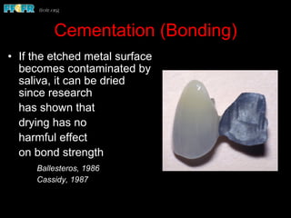 Cementation (Bonding)
•  If the etched metal surface
becomes contaminated by
saliva, it can be dried
since research
has shown that
drying has no
harmful effect
on bond strength
Ballesteros, 1986
Cassidy, 1987
 