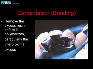 Cementation (Bonding)
•  Remove the
excess resin
before it
polymerizes,
particularly the
interproximal
excess
 