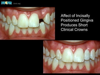 Affect of Incisally
Positioned Gingiva
Produces Short
Clinical Crowns
 