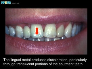 The lingual metal produces discoloration, particularly
through translucent portions of the abutment teeth
 