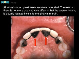 All resin bonded prostheses are overcontourted. The reason
there is not more of a negative affect is that the overcontouring
is usually located incisal to the gingival margin.
 