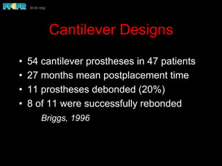 Cantilever Designs
•  54 cantilever prostheses in 47 patients
•  27 months mean postplacement time
•  11 prostheses debonded (20%)
•  8 of 11 were successfully rebonded
Briggs, 1996
 