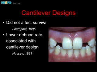 Cantilever Designs
•  Did not affect survival
Leempoel, 1995
•  Lower debond rate
associated with
cantilever design
Hussey, 1991
 