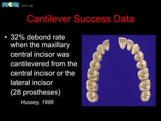 Cantilever Success Data
•  32% debond rate
when the maxillary
central incisor was
cantilevered from the
central incisor or the
lateral incisor
(28 prostheses)
Hussey, 1996
 