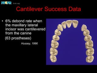 Cantilever Success Data
•  6% debond rate when
the maxillary lateral
incisor was cantilevered
from the canine
(63 prostheses)
Hussey, 1996
 