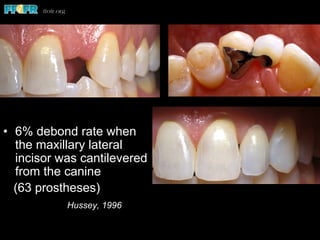 •  6% debond rate when
the maxillary lateral
incisor was cantilevered
from the canine
(63 prostheses)
Hussey, 1996
 