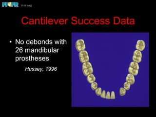 Cantilever Success Data
•  No debonds with
26 mandibular
prostheses
Hussey, 1996
 