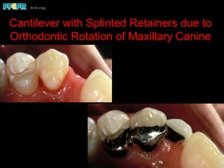 Cantilever with Splinted Retainers due to
Orthodontic Rotation of Maxillary Canine
 