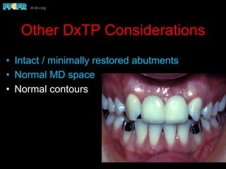 Other DxTP Considerations
•  Intact / minimally restored abutments
•  Normal MD space
•  Normal contours
 