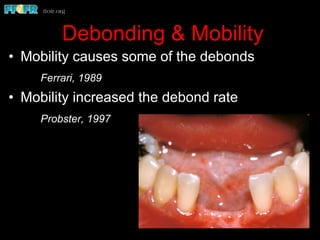 Debonding & Mobility
•  Mobility causes some of the debonds
Ferrari, 1989
•  Mobility increased the debond rate
Probster, 1997
 