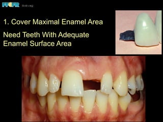 1. Cover Maximal Enamel Area
Need Teeth With Adequate
Enamel Surface Area
 