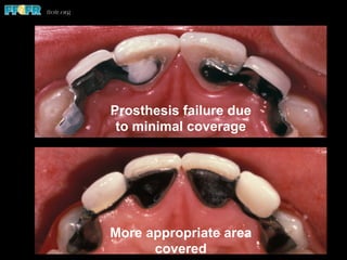 Prosthesis failure due
to minimal coverage
More appropriate area
covered
 