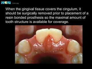 When the gingival tissue covers the cingulum, it
should be surgically removed prior to placement of a
resin bonded prosthesis so the maximal amount of
tooth structure is available for coverage.
 