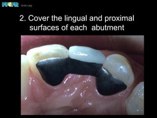 2. Cover the lingual and proximal
surfaces of each abutment
 