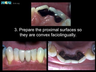 3. Prepare the proximal surfaces so
they are convex faciolingually.
 