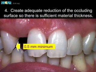 0.5 mm minimum
4. Create adequate reduction of the occluding
surface so there is sufficient material thickness.
 