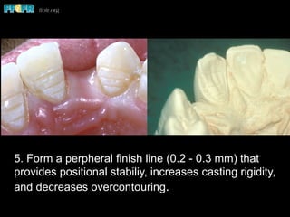 5. Form a perpheral finish line (0.2 - 0.3 mm) that
provides positional stabiliy, increases casting rigidity,
and decreases overcontouring.
 