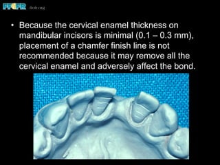 •  Because the cervical enamel thickness on
mandibular incisors is minimal (0.1 – 0.3 mm),
placement of a chamfer finish line is not
recommended because it may remove all the
cervical enamel and adversely affect the bond.
 