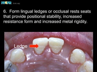 Ledge
6. Form lingual ledges or occlusal rests seats
that provide positional stability, increased
resistance form and increased metal rigidity.
 
