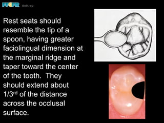 Rest seats should
resemble the tip of a
spoon, having greater
faciolingual dimension at
the marginal ridge and
taper toward the center
of the tooth. They
should extend about
1/3rd of the distance
across the occlusal
surface.
 