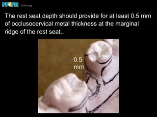 0.5
mm
The rest seat depth should provide for at least 0.5 mm
of occlusocervical metal thickness at the marginal
ridge of the rest seat..
 