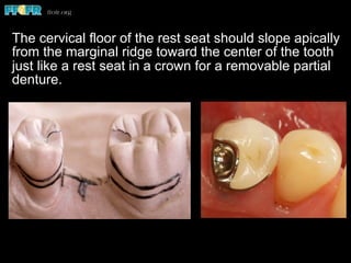 The cervical floor of the rest seat should slope apically
from the marginal ridge toward the center of the tooth
just like a rest seat in a crown for a removable partial
denture.
 