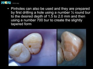 •  Pinholes can also be used and they are prepared
by first drilling a hole using a number ½ round bur
to the desired depth of 1.5 to 2.0 mm and then
using a number 700 bur to create the slightly
tapered form
 