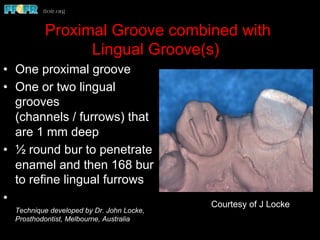 Proximal Groove combined with
Lingual Groove(s)
•  One proximal groove
•  One or two lingual
grooves
(channels / furrows) that
are 1 mm deep
•  ½ round bur to penetrate
enamel and then 168 bur
to refine lingual furrows
• 
Technique developed by Dr. John Locke,
Prosthodontist, Melbourne, Australia
Courtesy of J Locke
 