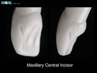Maxillary Central Incisor
 