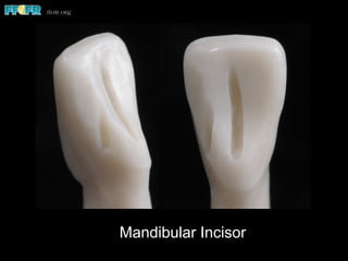 Mandibular Incisor
 