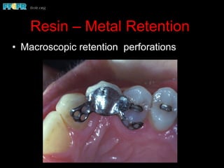Resin – Metal Retention
•  Macroscopic retention perforations
 