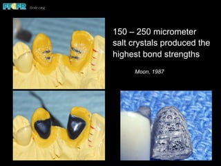 150 – 250 micrometer
salt crystals produced the
highest bond strengths
Moon, 1987
 